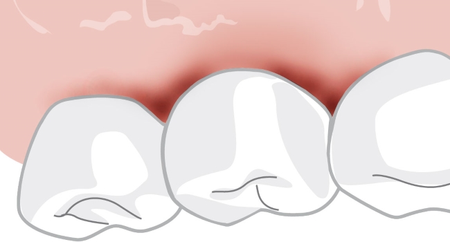 Grafik: entzündetes Zahnfleisch